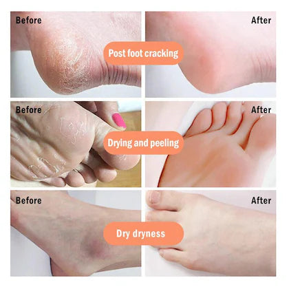 Silicone Heel Protector –, Repair Cracked Heels, Reduce Pain & Soften Skin